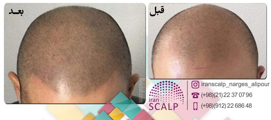 مرکز میکرو اسکالپ اسکالپ سر