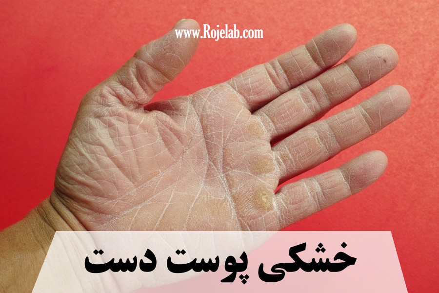خشکی پوست دست
