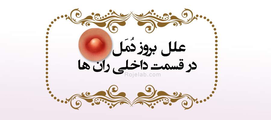 دمل یا جوش چرکی یک بیماری پوستی است که به دلیل وجود باکتری ها در محیط های گرم و مرطوب به وجود می آید در این مقاله از سایت آرایش و زیبایی رژلب روش های درمان فوری آن توضیح داده شده است