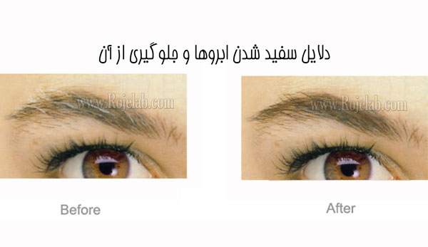 سفید شدن ابرو